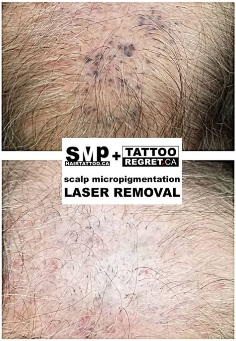 scalp micropigmentation regret|scalp micropigmentation removal.